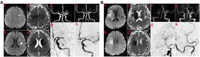 Intracranial Atherosclerotic Disease-Related Acute Middle Cerebral Artery Occlusion Can Be Predicted by Diffusion-Weighted Imaging